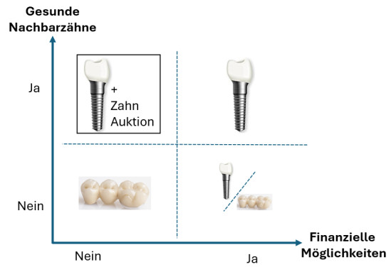 Zahnbrücke über Implantat - eine Entscheidungshilfe