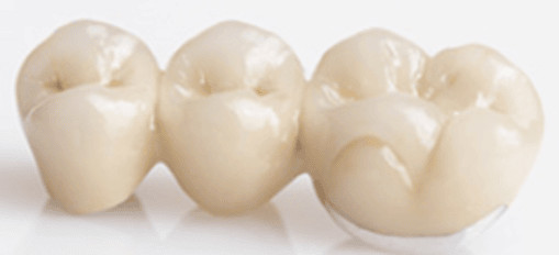 Zahnbrücke aus Vollkeramik 