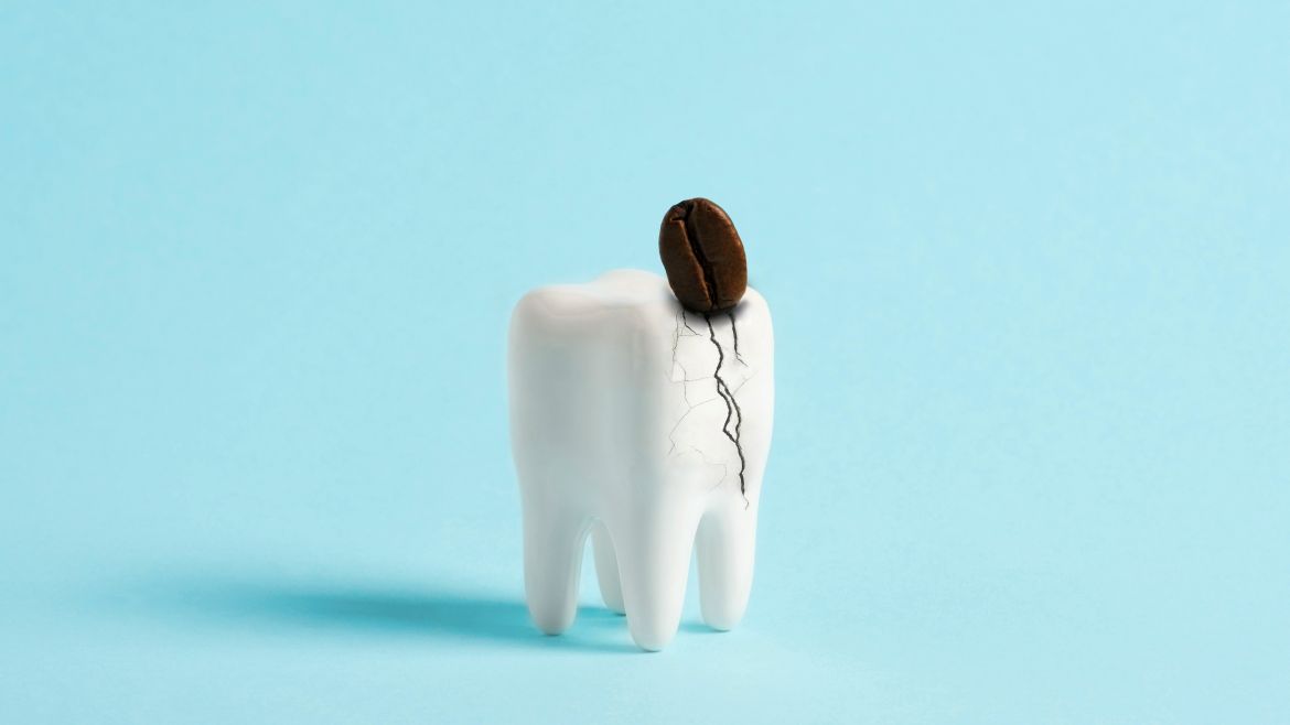 Ein unglücklicher Biss reicht für eine Zahnfraktur.